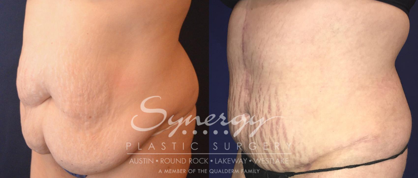 Fleur Di Lis Tummy Tuck