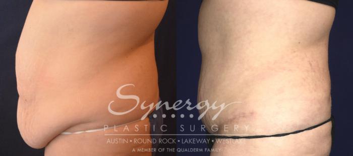 Fleur Di Lis Tummy Tuck