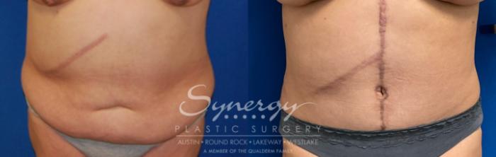 Fleur Di Lis Tummy Tuck