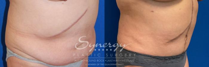 Fleur Di Lis Tummy Tuck