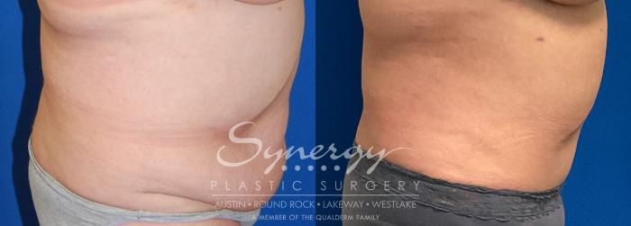 Fleur Di Lis Tummy Tuck