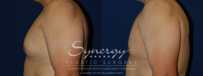 Before & After  Case 109 View #2 View in Austin, TX