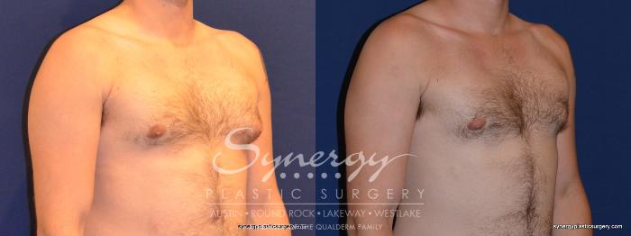 Before & After  Case 282 View #3 View in Austin, TX