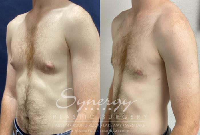 Before & After  Case 894 Left Oblique View in Austin, TX