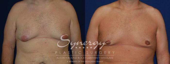 Before & After  Case 92 View #3 View in Austin, TX