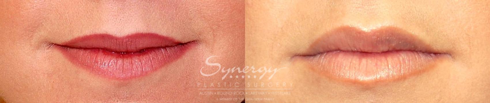 Before & After  Case 16 View #1 View in Austin, TX