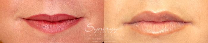 Before & After  Case 16 View #1 View in Austin, TX