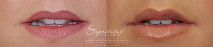 Before & After  Case 16 View #2 View in Austin, TX