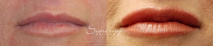 Before & After Injectable Fillers (Lips) Case 18 View #1 View in Austin, TX