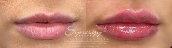 before and after Lip Filler