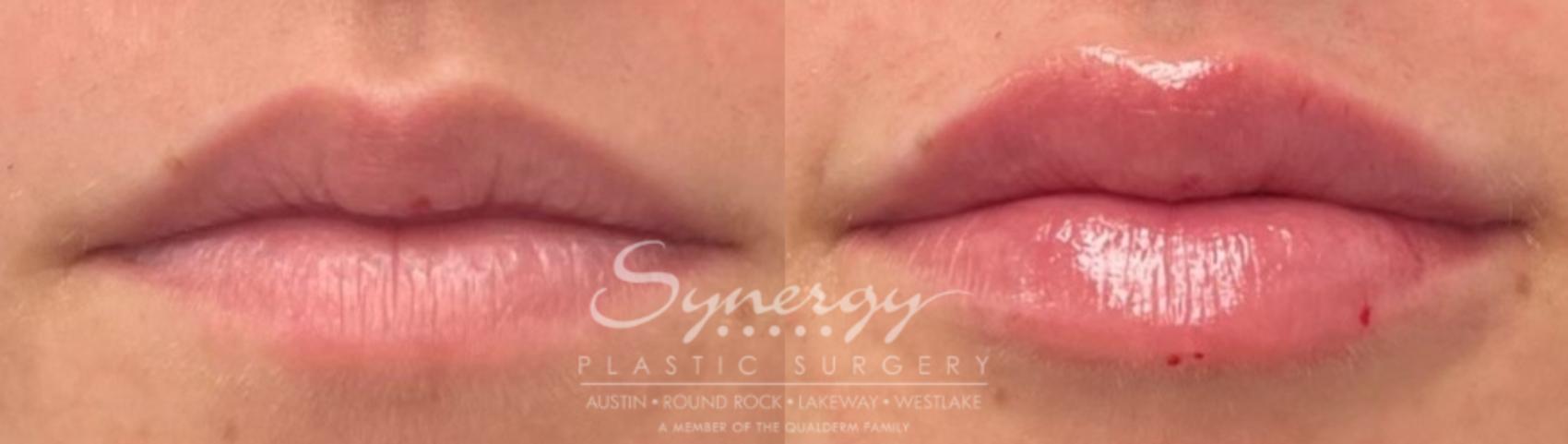 before and after Lip Filler