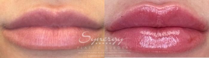 Before & After Injectable Fillers (Lips) Case 846 Front View in Austin, TX