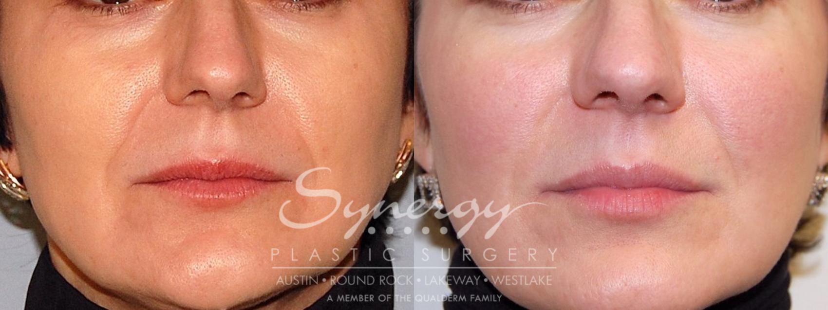 Before & After Injectable Fillers (Wrinkles) Case 19 View #1 View in Austin, TX