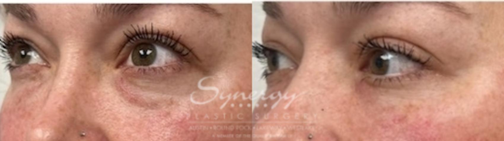 Before & After Injectable Fillers (Wrinkles) Case 853 Right Oblique View in Austin, TX