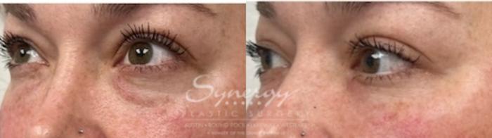 Before & After  Case 853 Right Oblique View in Austin, TX