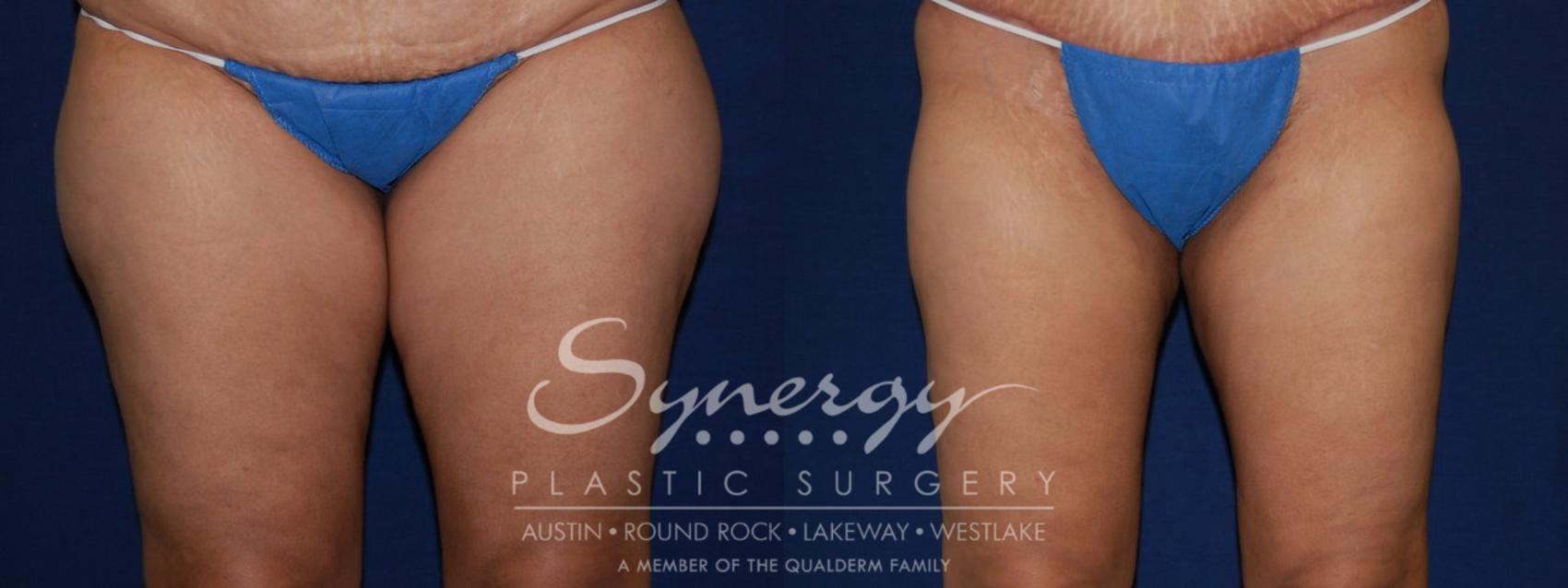 Before & After Liposuction Case 107 View #1 View in Austin, TX