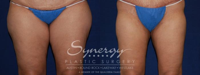 Before & After Liposuction Case 107 View #1 View in Austin, TX