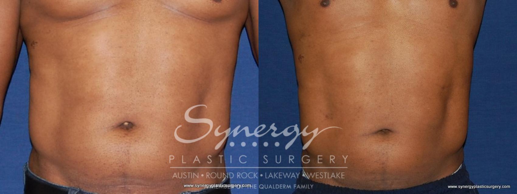 Before & After Liposuction Case 191 View #1 View in Austin, TX