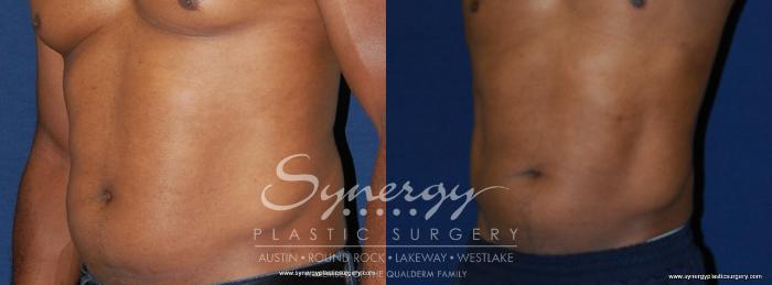 Before & After  Case 191 View #3 View in Austin, TX