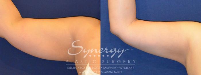 Before & After  Case 287 View #3 View in Austin, TX