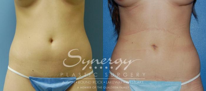 Before & After  Case 29 View #3 View in Austin, TX