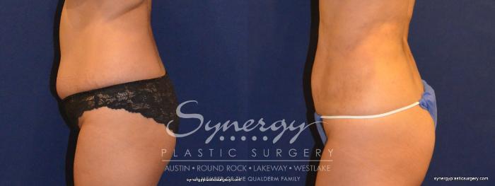 Before & After  Case 323 View #2 View in Austin, TX