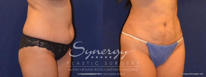 Before & After  Case 323 View #3 View in Austin, TX