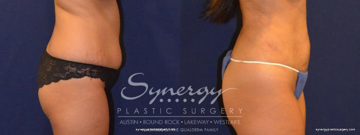 Before & After  Case 323 View #4 View in Austin, TX