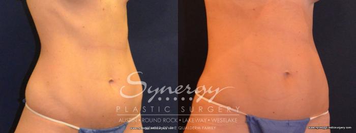 Before & After Liposuction Case 432 View #2 View in Austin, TX