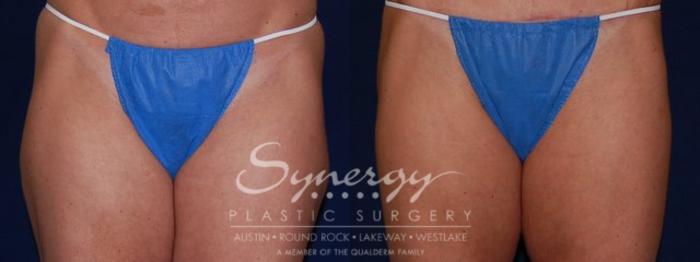 Before & After Liposuction Case 49 View #1 View in Austin, TX