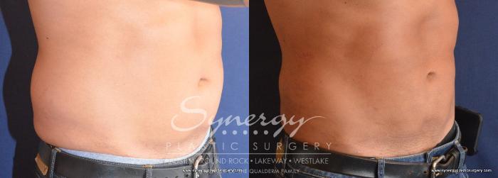 Before & After  Case 713 View #2 View in Austin, TX