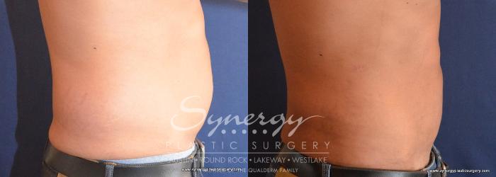 Before & After  Case 713 View #3 View in Austin, TX