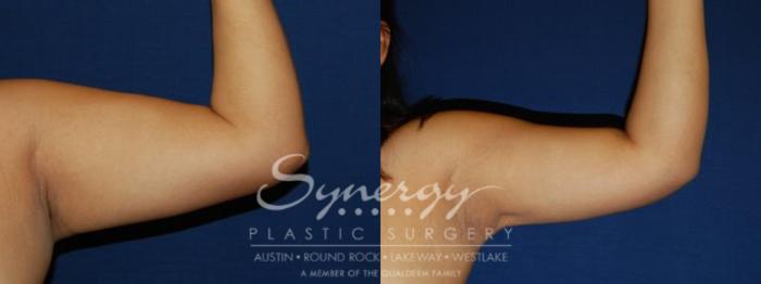 Before & After  Case 76 View #1 View in Austin, TX