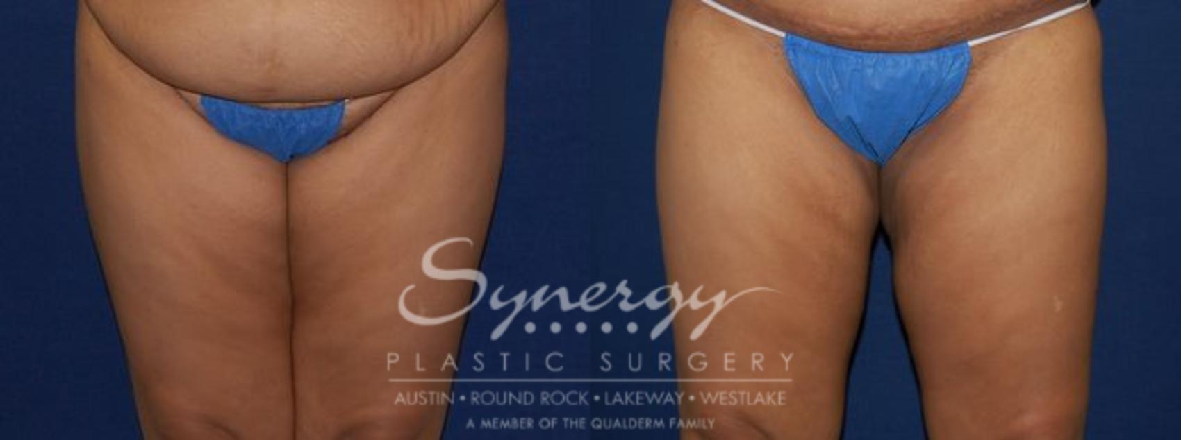 Before & After  Case 77 View #1 View in Austin, TX