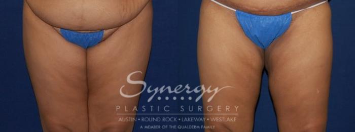 Before & After Liposuction Case 77 View #1 View in Austin, TX