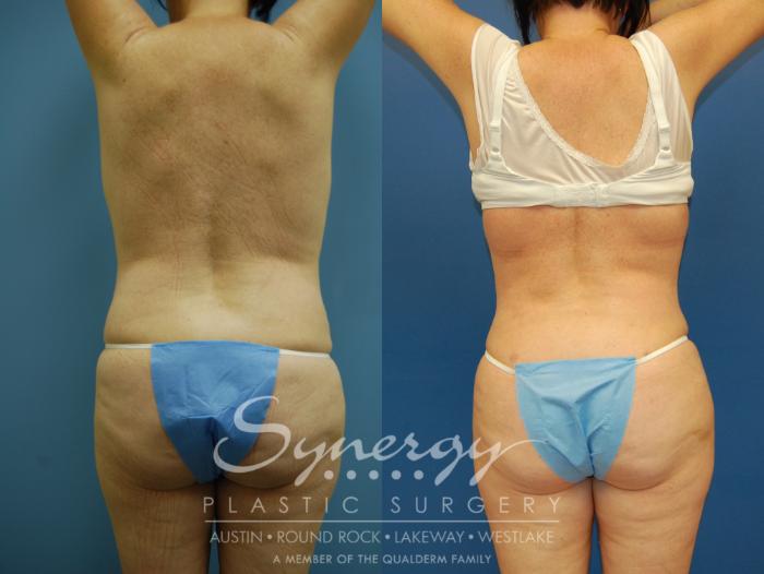 Before & After Liposuction Case 8 View #6 View in Austin, TX