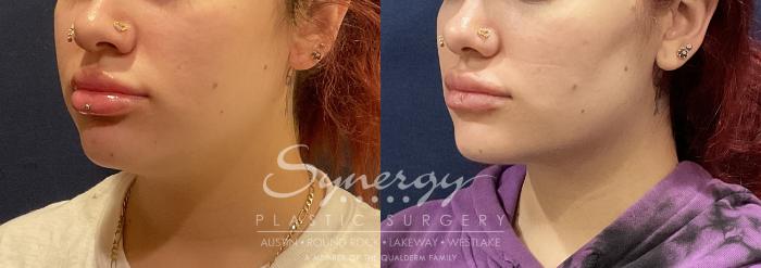 Before & After Liposuction Case 811 Right Oblique View in Austin, TX