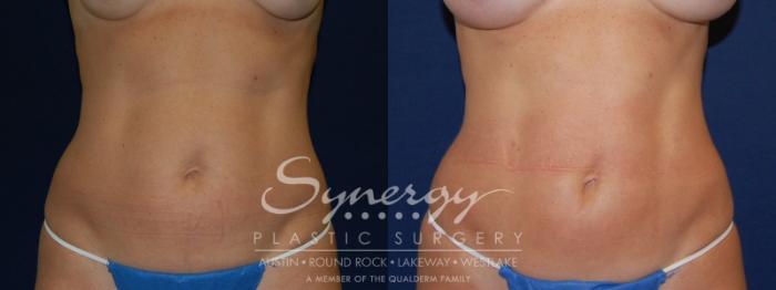 Before & After  Case 84 View #1 View in Austin, TX