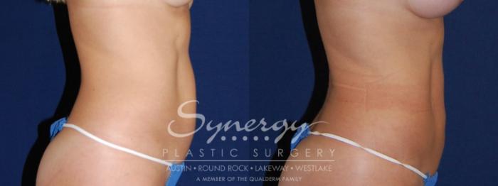 Before & After  Case 84 View #2 View in Austin, TX