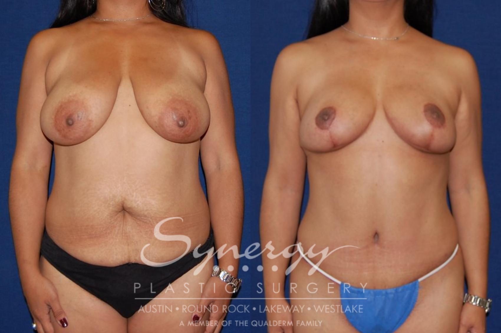 Before & After  Case 113 View #1 View in Austin, TX