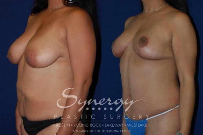 Before & After  Case 113 View #2 View in Austin, TX