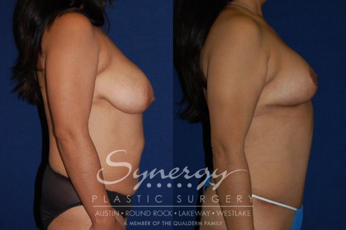 Before & After  Case 113 View #3 View in Austin, TX