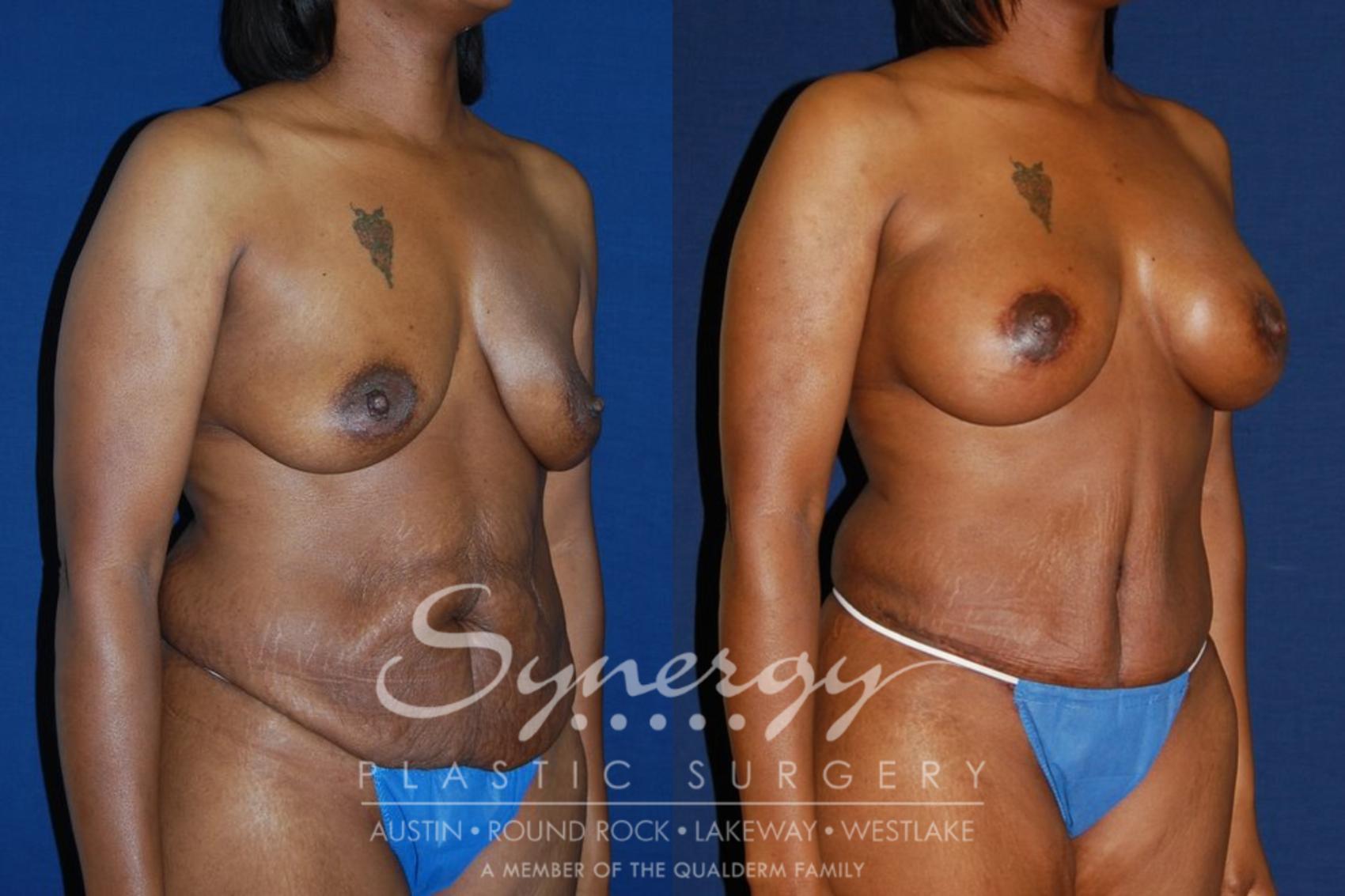 Before & After Mommy Makeover Case 129 View #1 View in Austin, TX