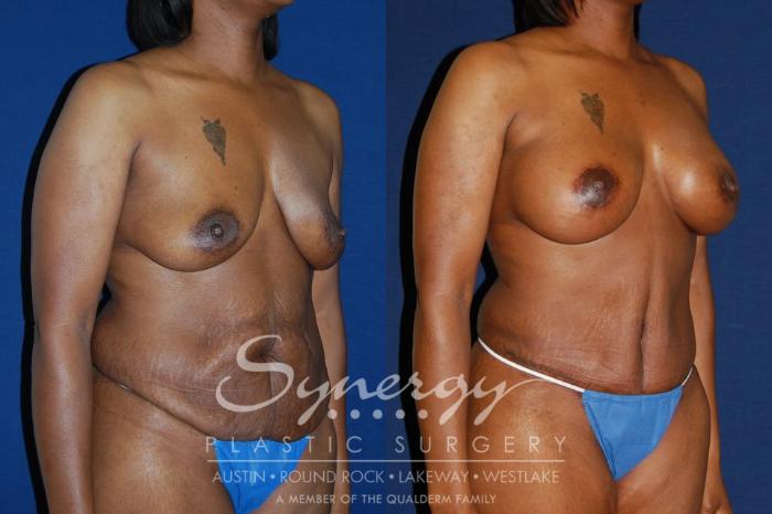 Before & After Mommy Makeover Case 129 View #1 View in Austin, TX