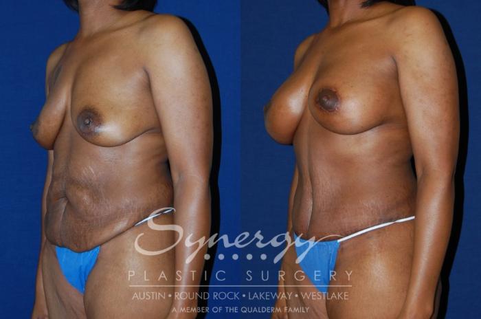 Before & After Mommy Makeover Case 129 View #2 View in Austin, TX