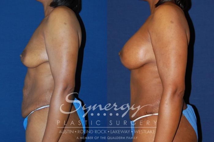 Before & After Mommy Makeover Case 129 View #3 View in Austin, TX