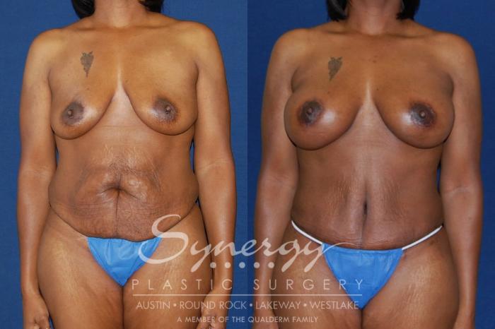 Before & After Mommy Makeover Case 129 View #4 View in Austin, TX