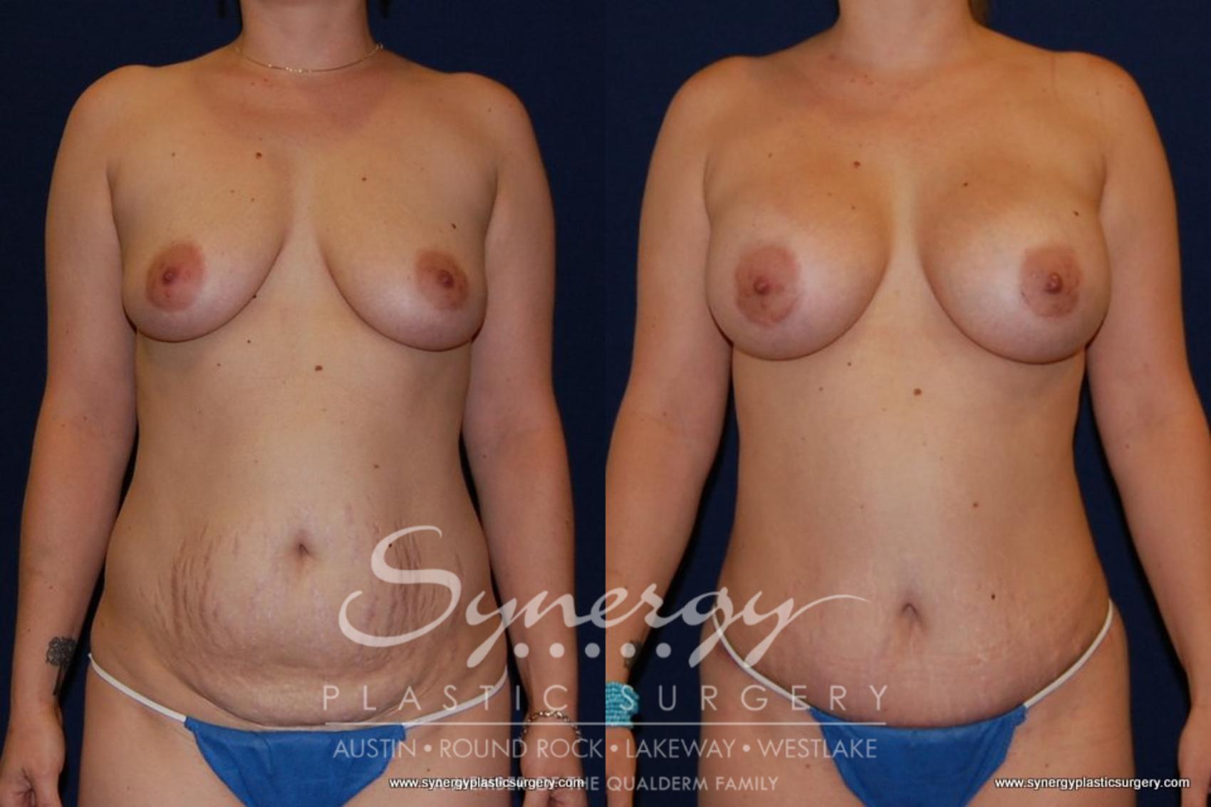 Before & After Mommy Makeover Case 150 View #1 View in Austin, TX