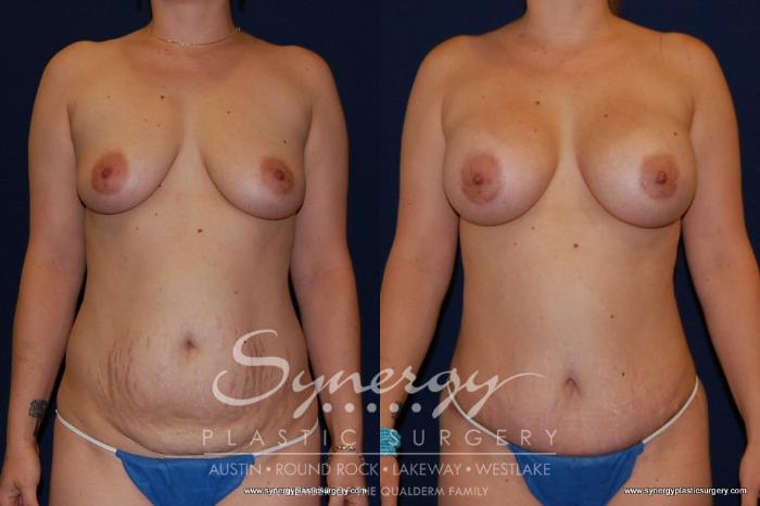 Before & After  Case 150 View #1 View in Austin, TX