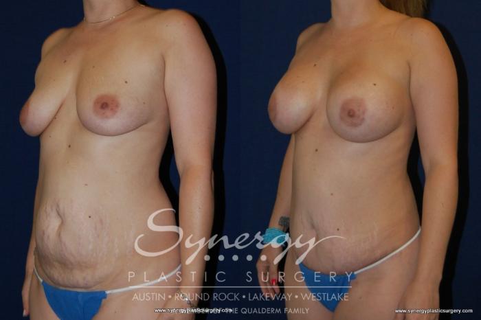 Before & After  Case 150 View #2 View in Austin, TX